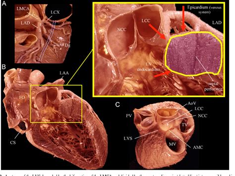 How to map and ablate left ventricular summit 